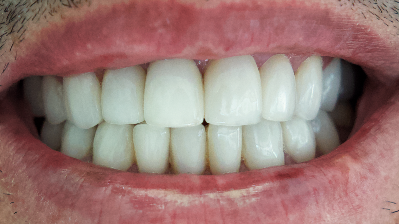 Sourire après hollywood smile